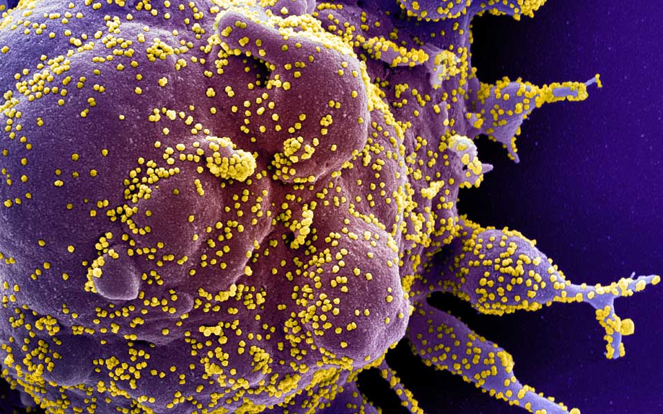 Apoptotische Zelle die stark mit SARS-CoV-2 Viruspartikel infiziert ist